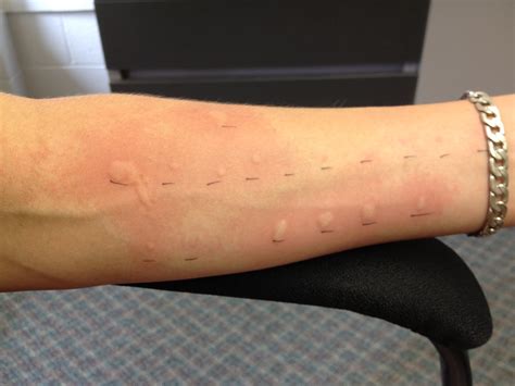 scratch test hives|allergic reaction to hives pictures.